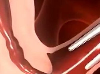 未婚去承德做三代试管需要花费多少钱？费用明细是怎么样的？